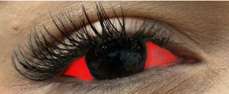 Eye disease